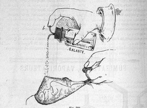 anestesia erogatore goccia  a goccia Larousse Mdical Illustr